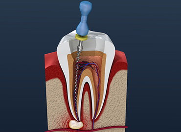 Endodontik Tedavi